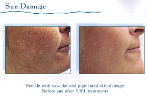 Chicago Laser Skin Rejuvenation